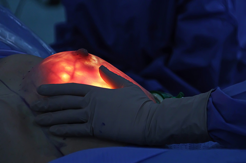 mastectomy