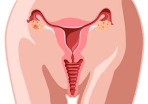 cáncer de cérvix