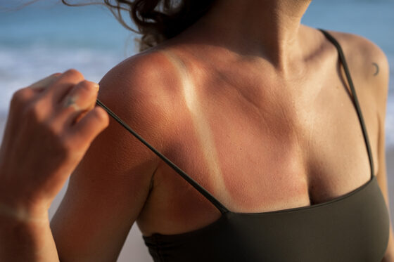 Llega el verano: Cuidado con las quemaduras del sol