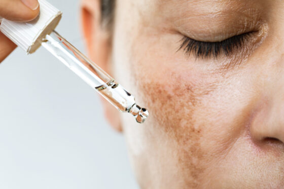 Manchas en la piel durante el embarazo: qué es el melasma gestacional