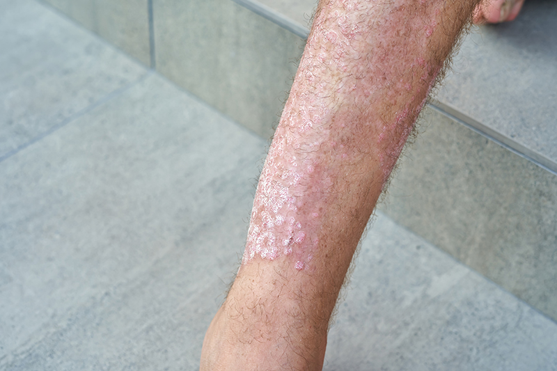 Psoriasis