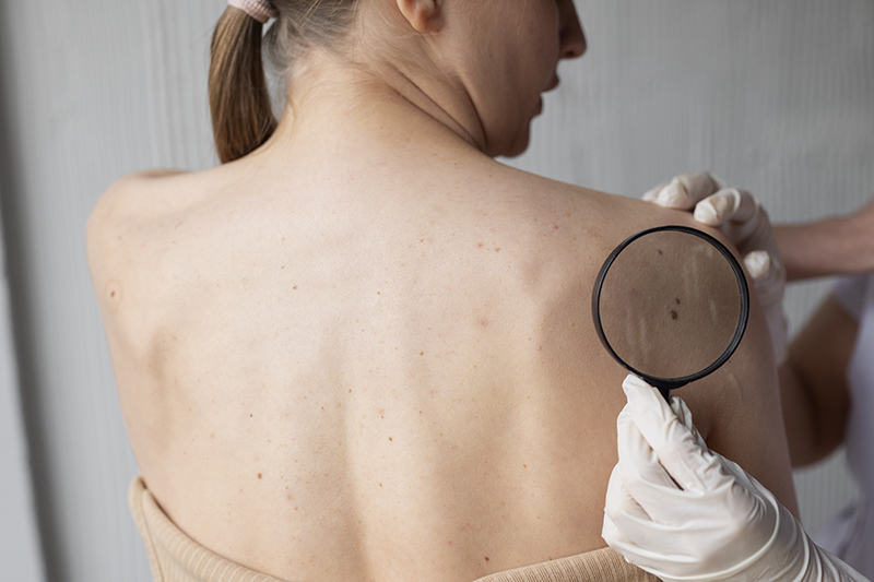 doctora diagnosticando un melanoma en el cuerpo de una paciente