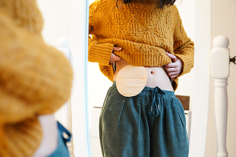 mujer con colostomia