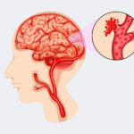 Ilustración de aneurisma cerebral en una arteria del cerebro