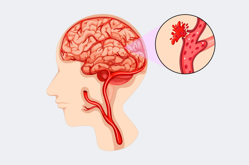Ilustración de aneurisma cerebral en una arteria del cerebro