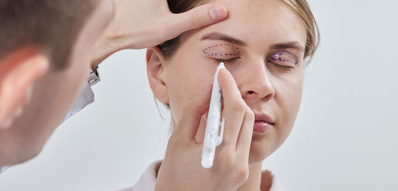 Consulta en blefaroplastia