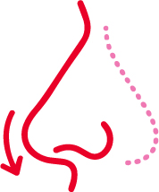Rinoplastia para punta nasal caída o ancha