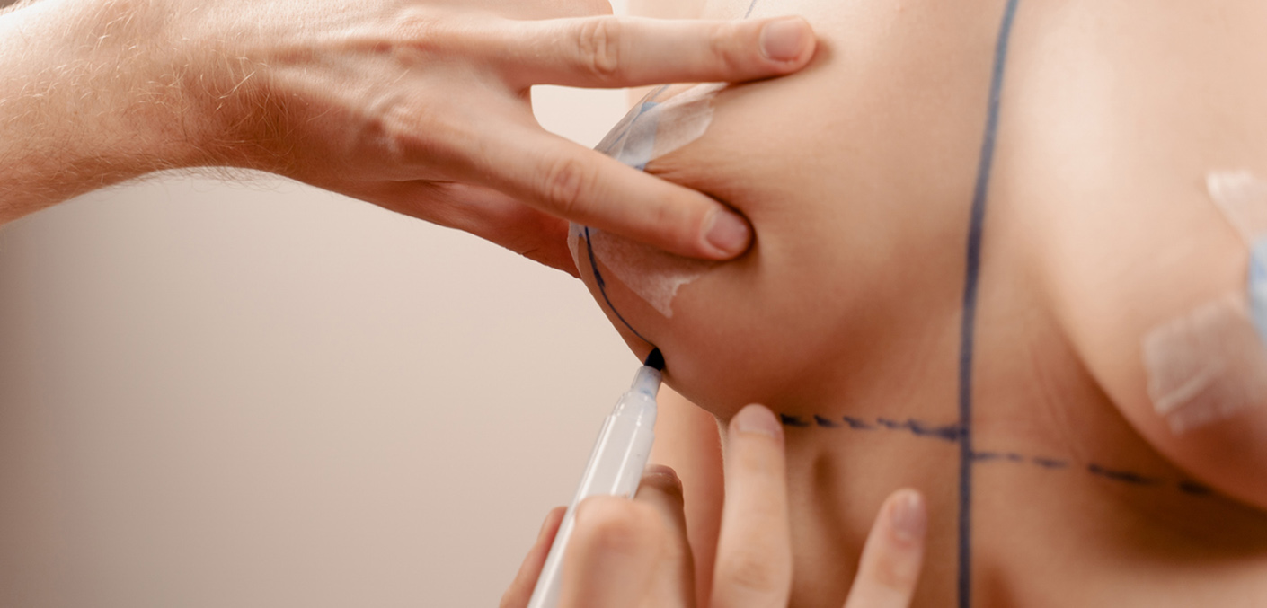 Cirugía adaptada a la anatomía