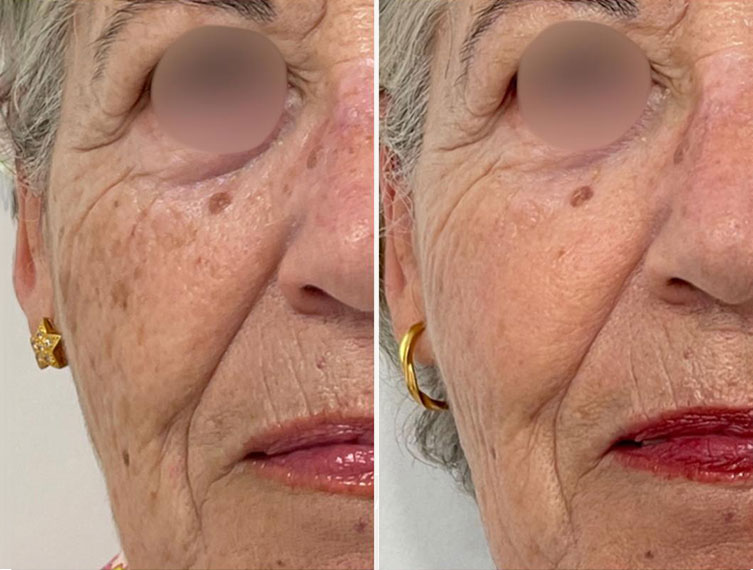 Antes y después del tratamiento IPL