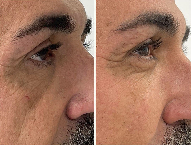 Antes y después del tratamiento de ojeras con ácido hialurónico