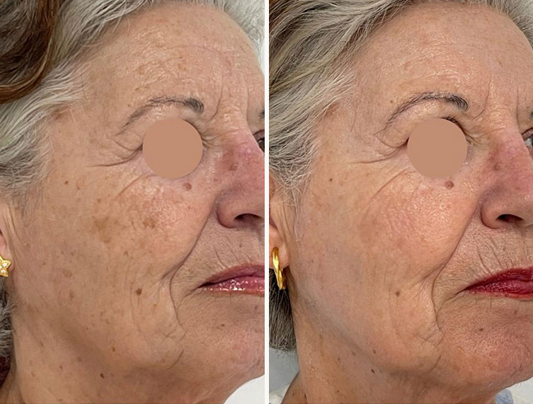 Antes y después del tratamiento IPL
