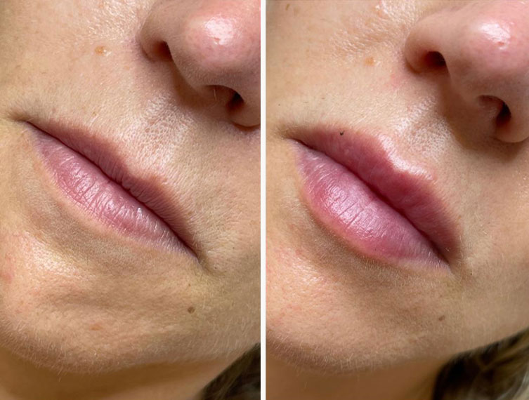 Antes y después del aumento de labios