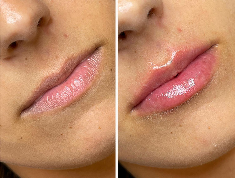 Antes y después del aumento de labios