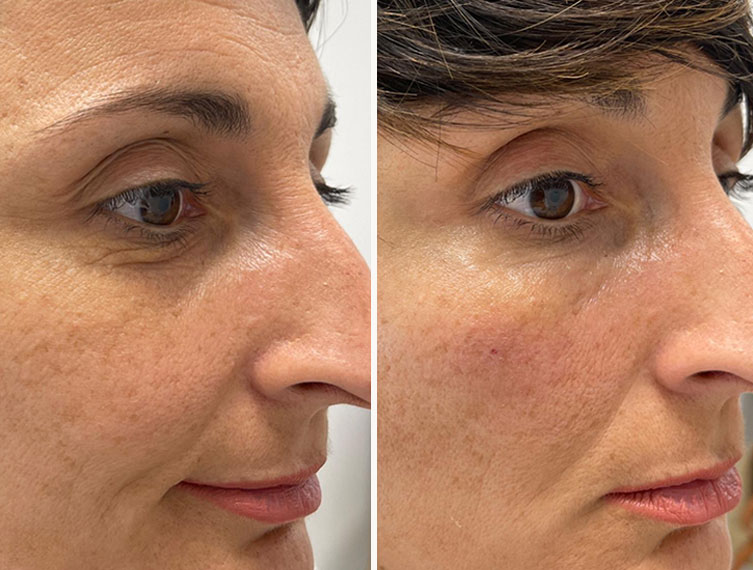 Antes y después del tratamiento de ojeras con ácido hialurónico en Valencia