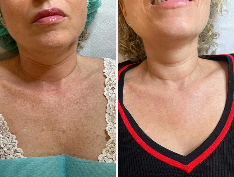 Antes y después del tratamiento IPL para manchas