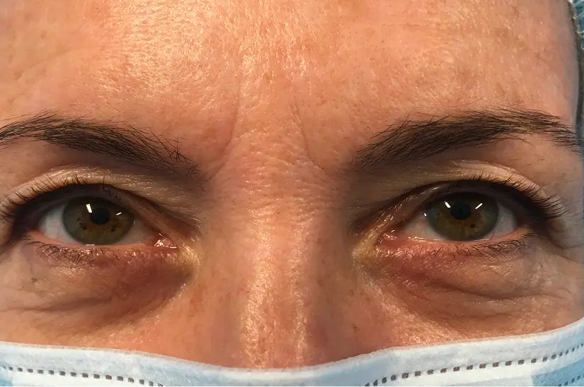 Antes de la Blefaroplastia