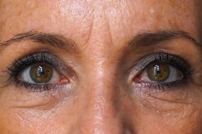 Después de la Blefaroplastia