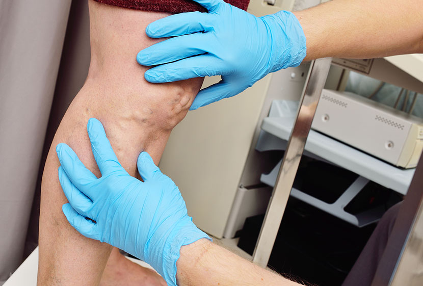 Valoración vascular especializada de la enfermedad venosa