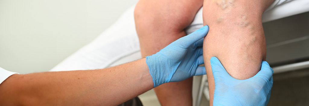 Consulta de angiología en el Hospital Ribera Covadonga, Gijón. Evaluación de la circulación