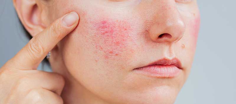 Tratamiento de rosácea y cuperosis en Vigo