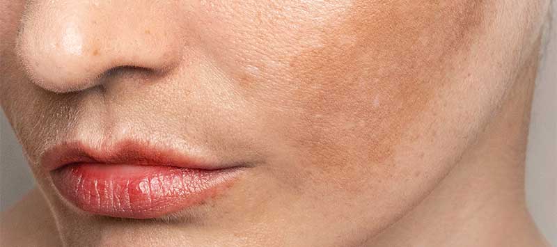 Tratamiento del melasma y manchas solares en Vigo