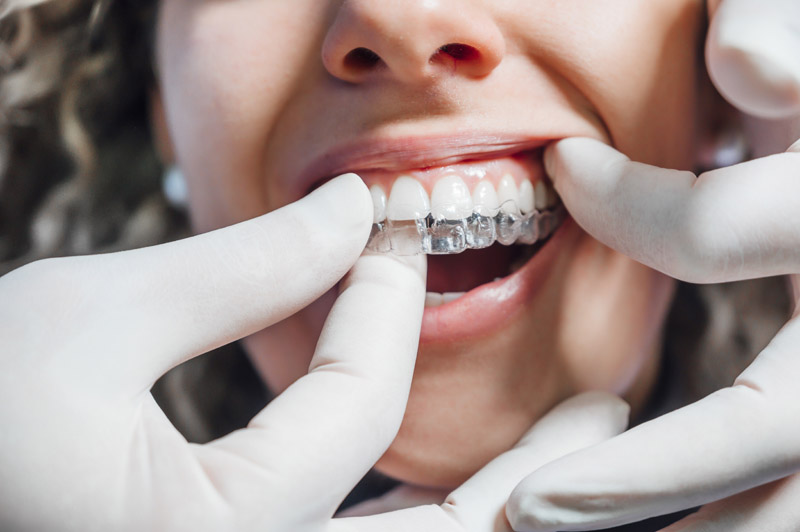Cómo limpiar y mantener en buen estado las férulas dentales? - Clínica  Dental Molina