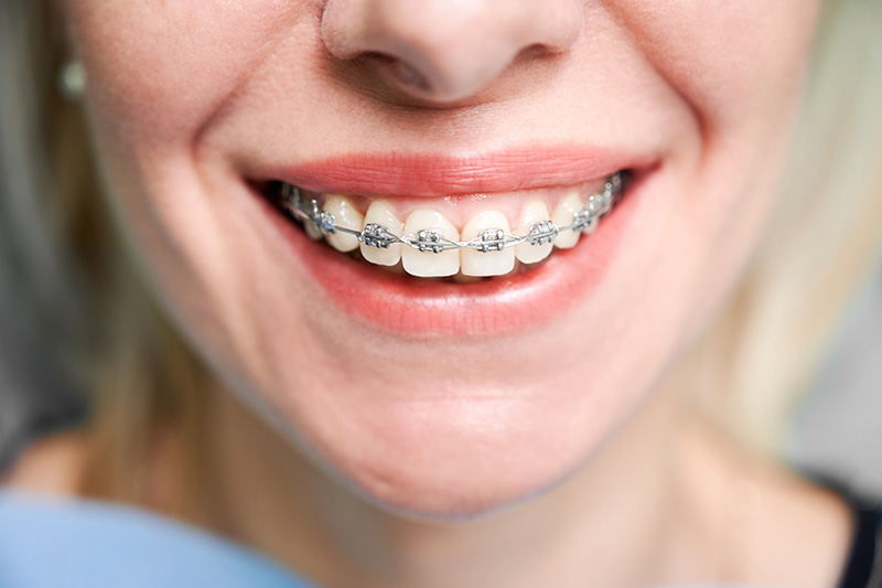 mujer joven sonriente frenos dientes