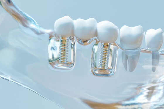 Partes de un implante dental