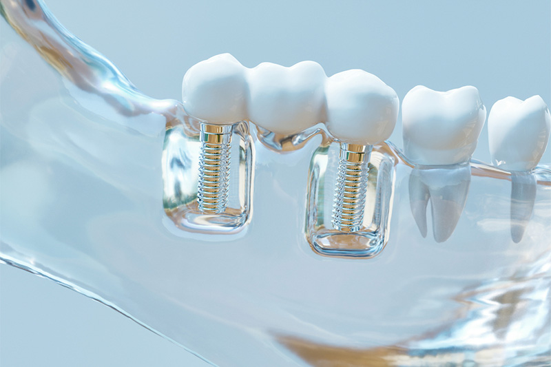 Partes de un implante dental