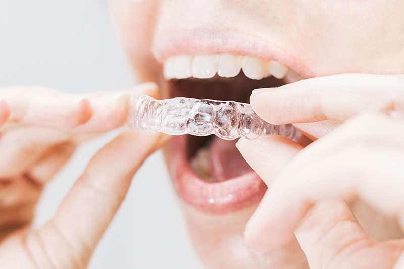 Trucos efectivos para manejar la salida con Invisalign