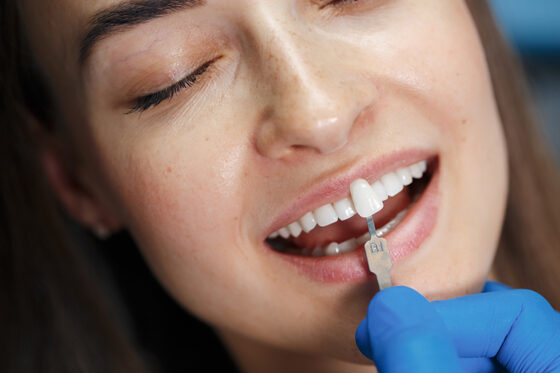 Requisitos para ponerse carillas dentales: qué necesitas saber antes de empezar