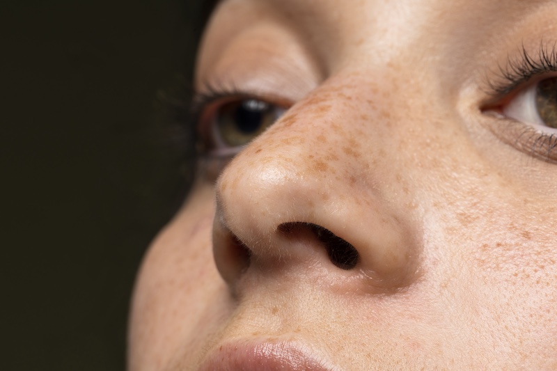 melasma