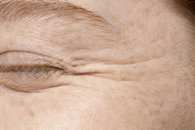 : cómo prevenir arrugas y flacidez