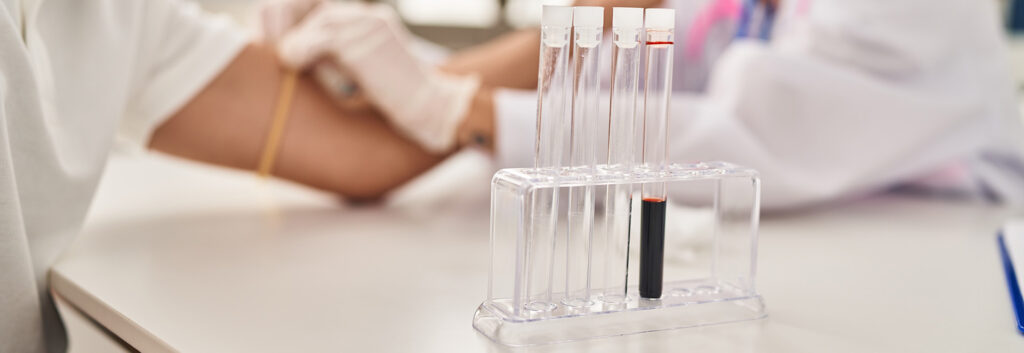 Test genetico Alzheimer